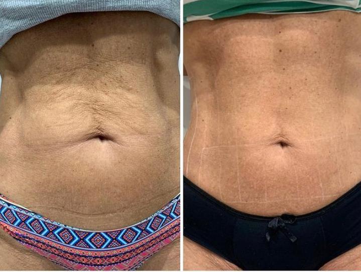 antes e depois -Ultraformer corporal